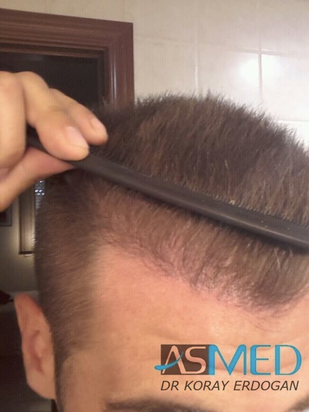 Before and After  graft    transplant at 