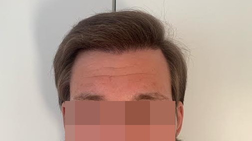 FUE Hair Transplant Result