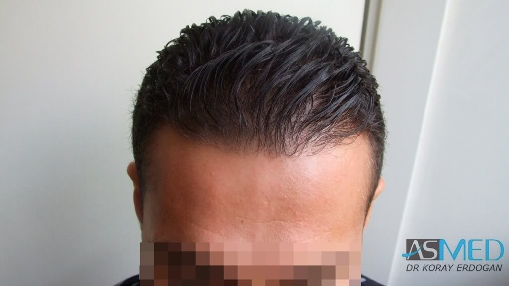Before and After 1250 graft  FUE hair transplant at ASMED Medical Center