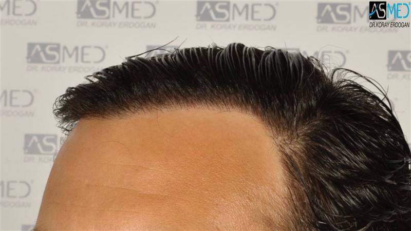 Before and After  graft    transplant at 