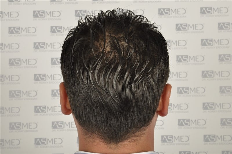 Before and After  graft    transplant at 