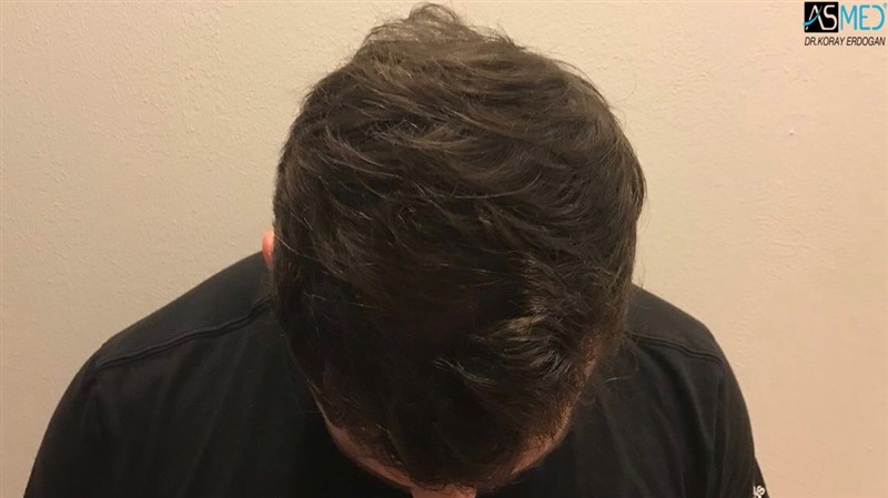 FUE Hair Transplant Result