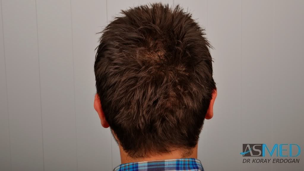 Before and After  graft    transplant at 
