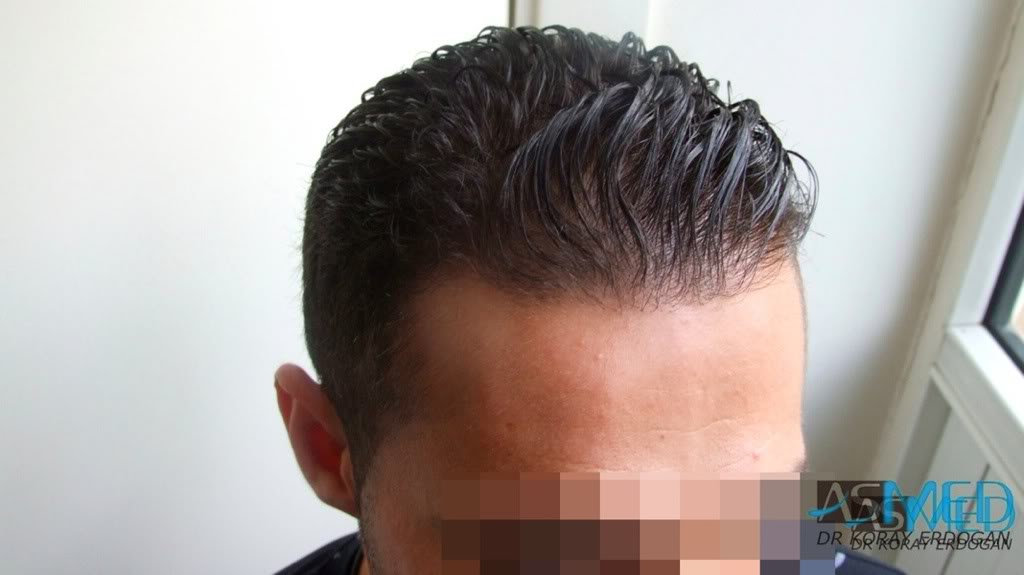 Before and After  graft    transplant at 