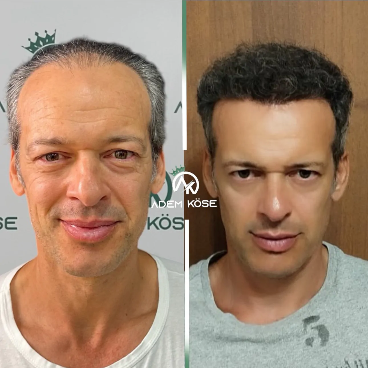 DHI Hair Transplant Result