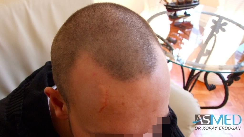 Before and After  graft    transplant at 