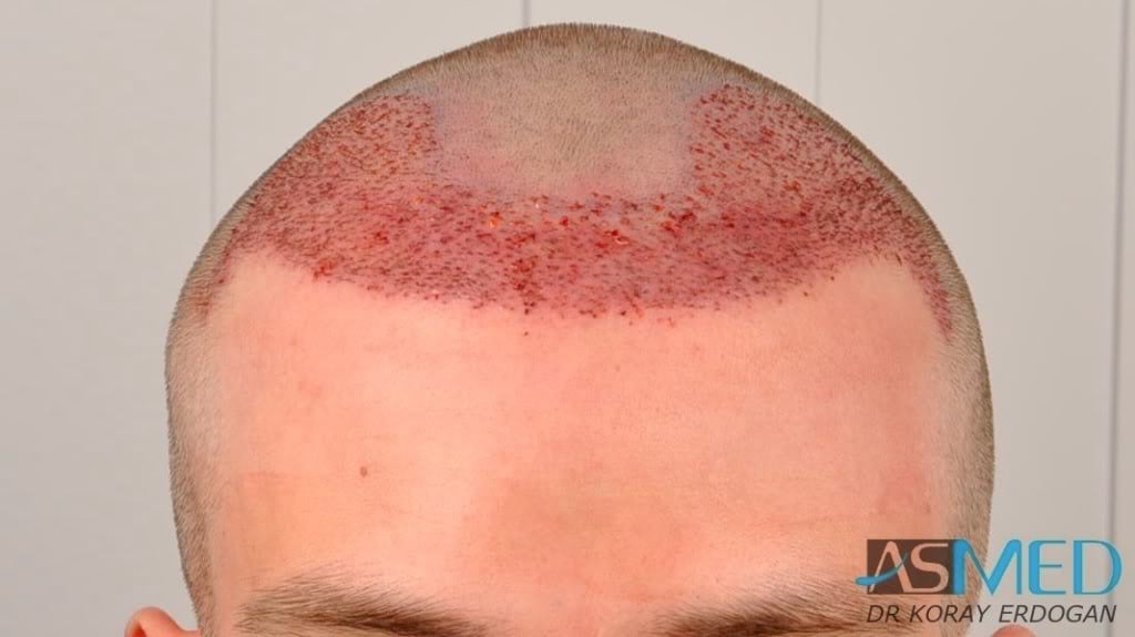 Before and After  graft    transplant at 