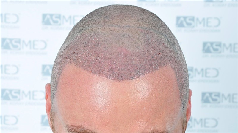 Before and After  graft    transplant at 