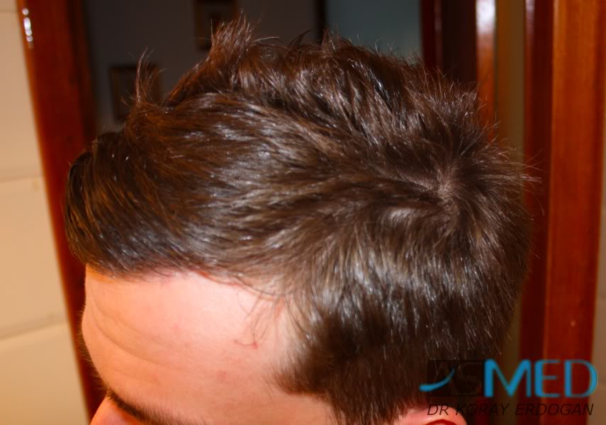 Before and After  graft    transplant at 