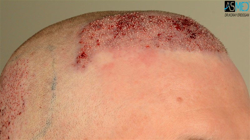 Before and After  graft    transplant at 