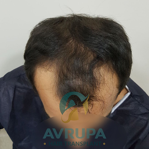 Before and After  graft    transplant at 