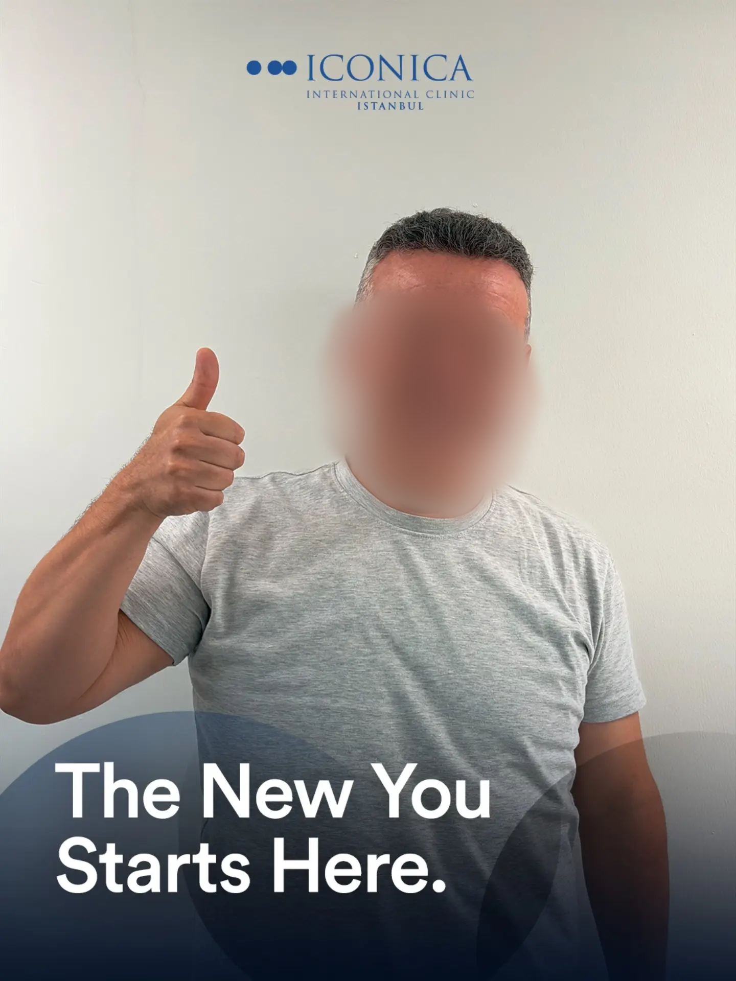 4600 graft DHI hair transplant result before and after