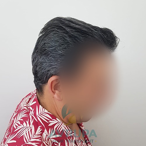 Before and After  graft    transplant at 