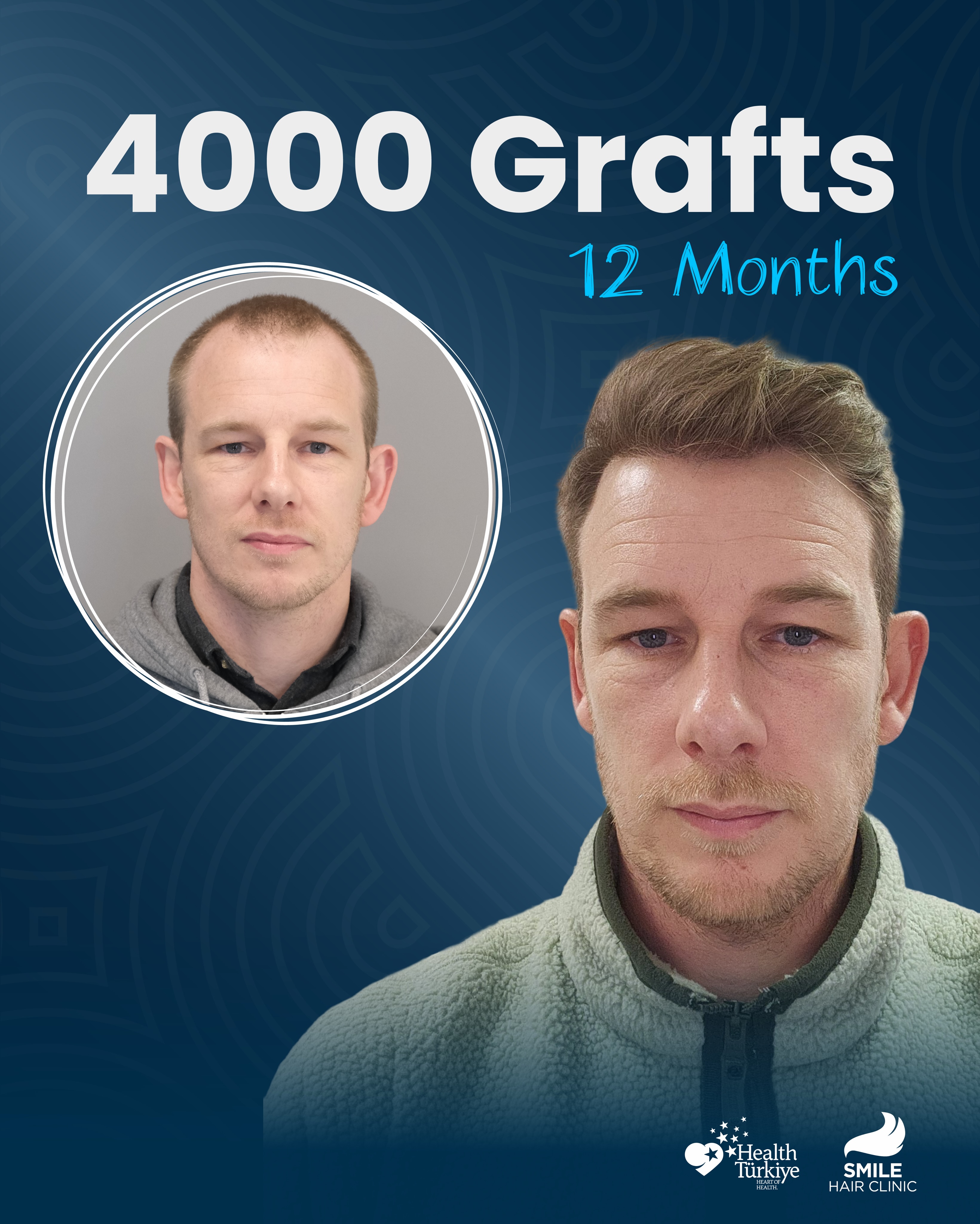 Before and After  graft    transplant at 