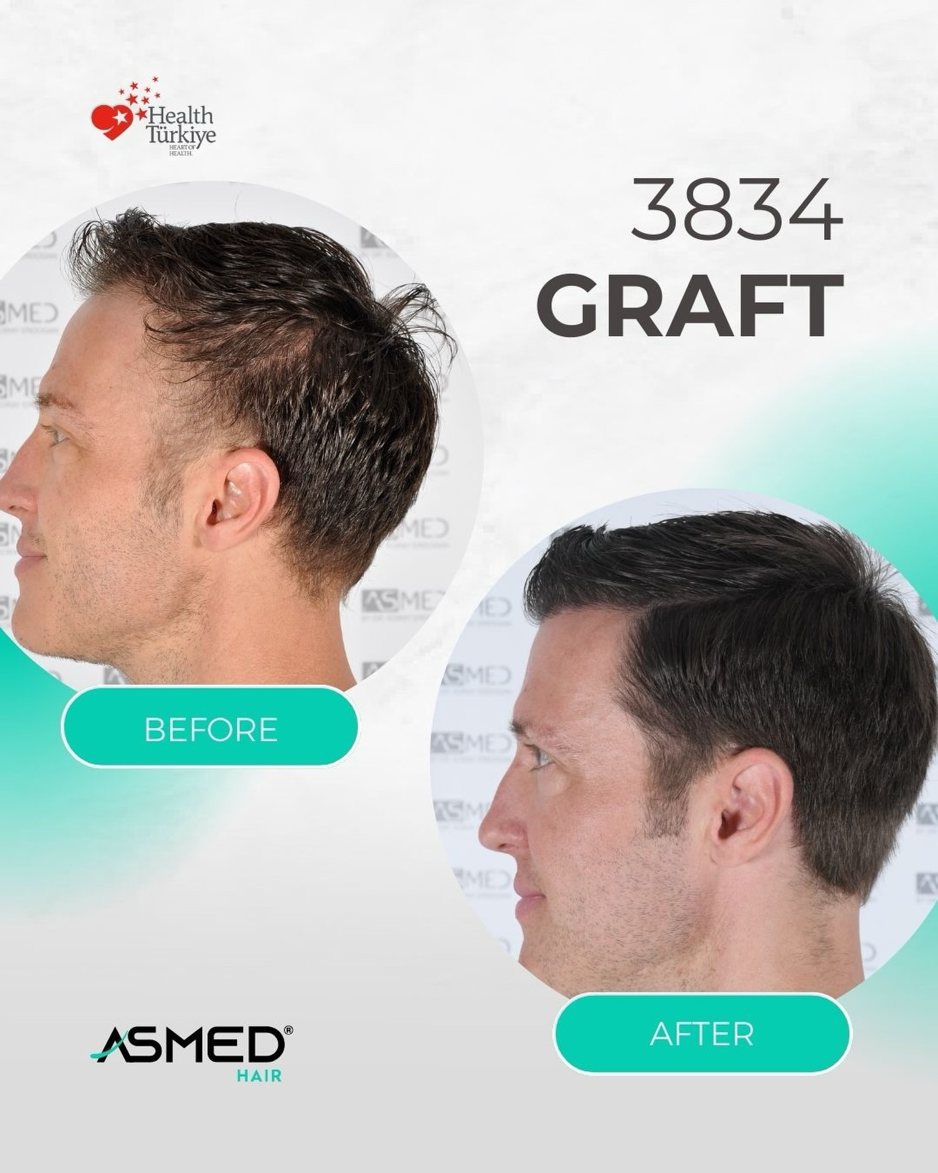 FUE Hair Transplant Result