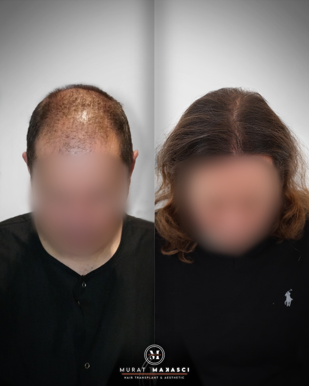 5800 graft FUE hair transplant result before and after