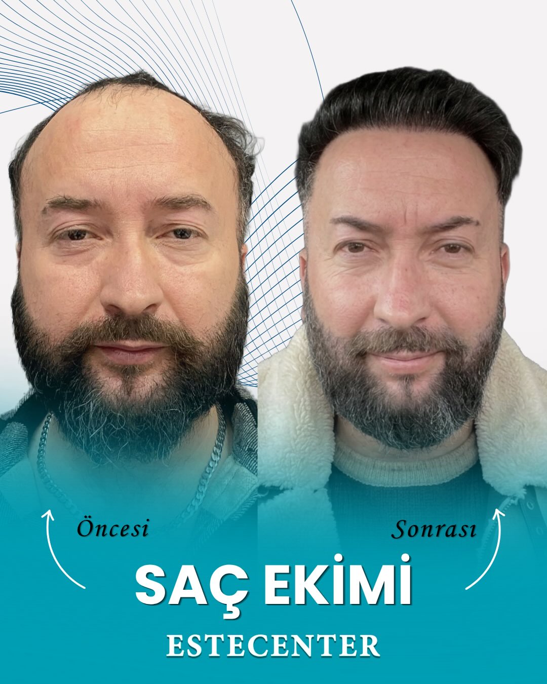 Before and After 3500 graft  SAFIR hair transplant at Estecenter