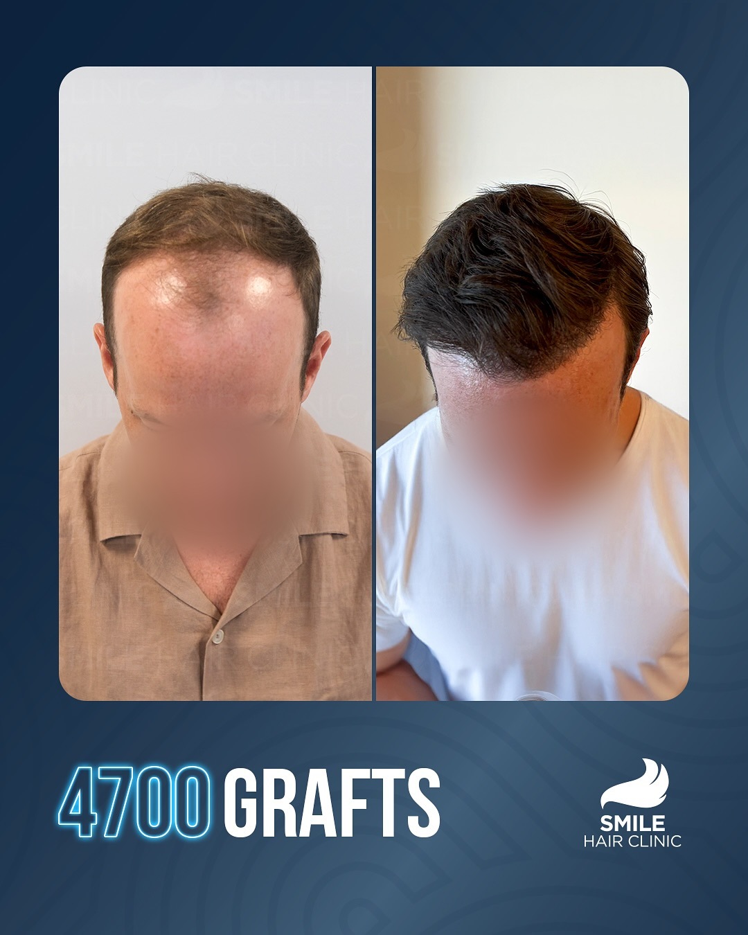 Before and After  graft    transplant at 