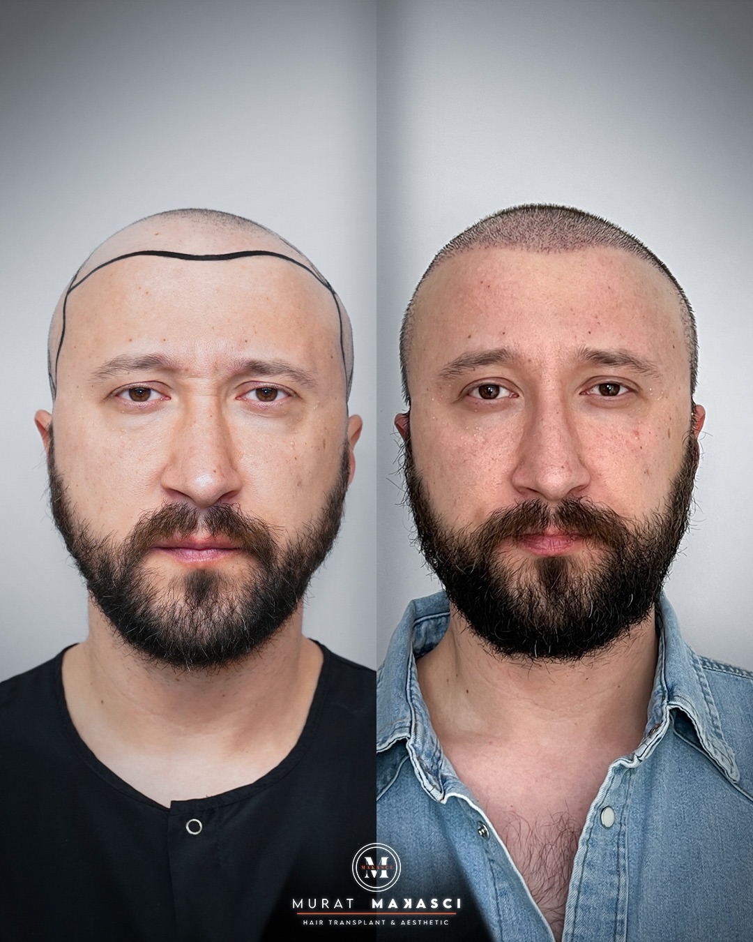 5650 grafts DHI hair transplant result before and after