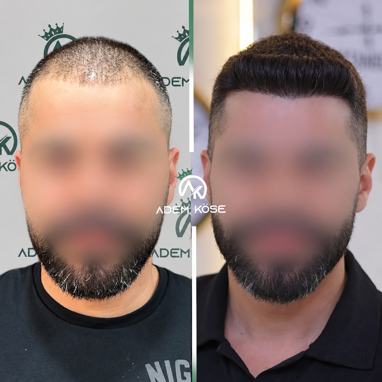 2333 graft FUE hair transplant result before and after