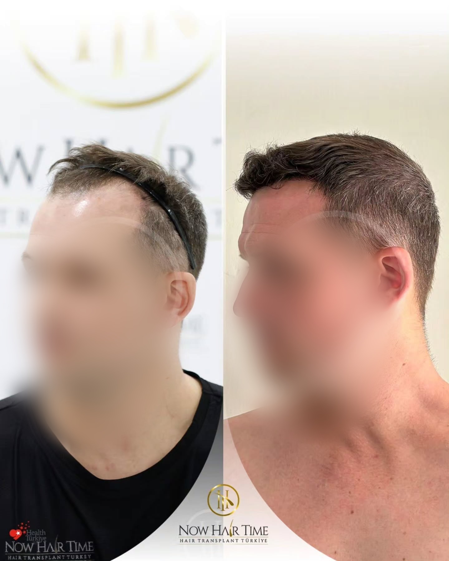 Before and After  graft    transplant at 