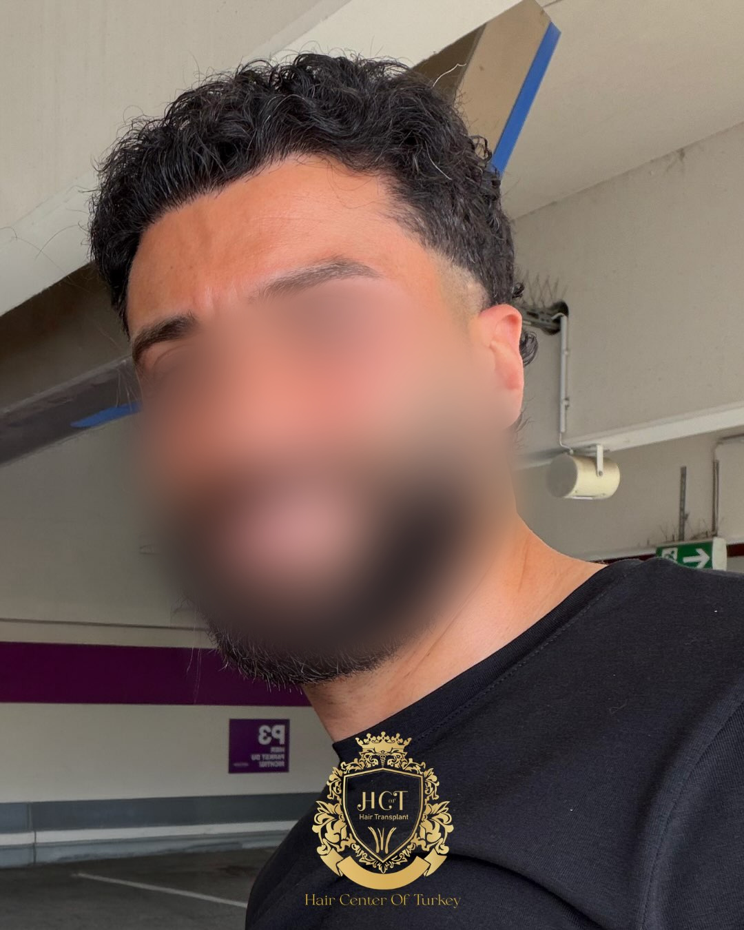 FUE Hair Transplant Result