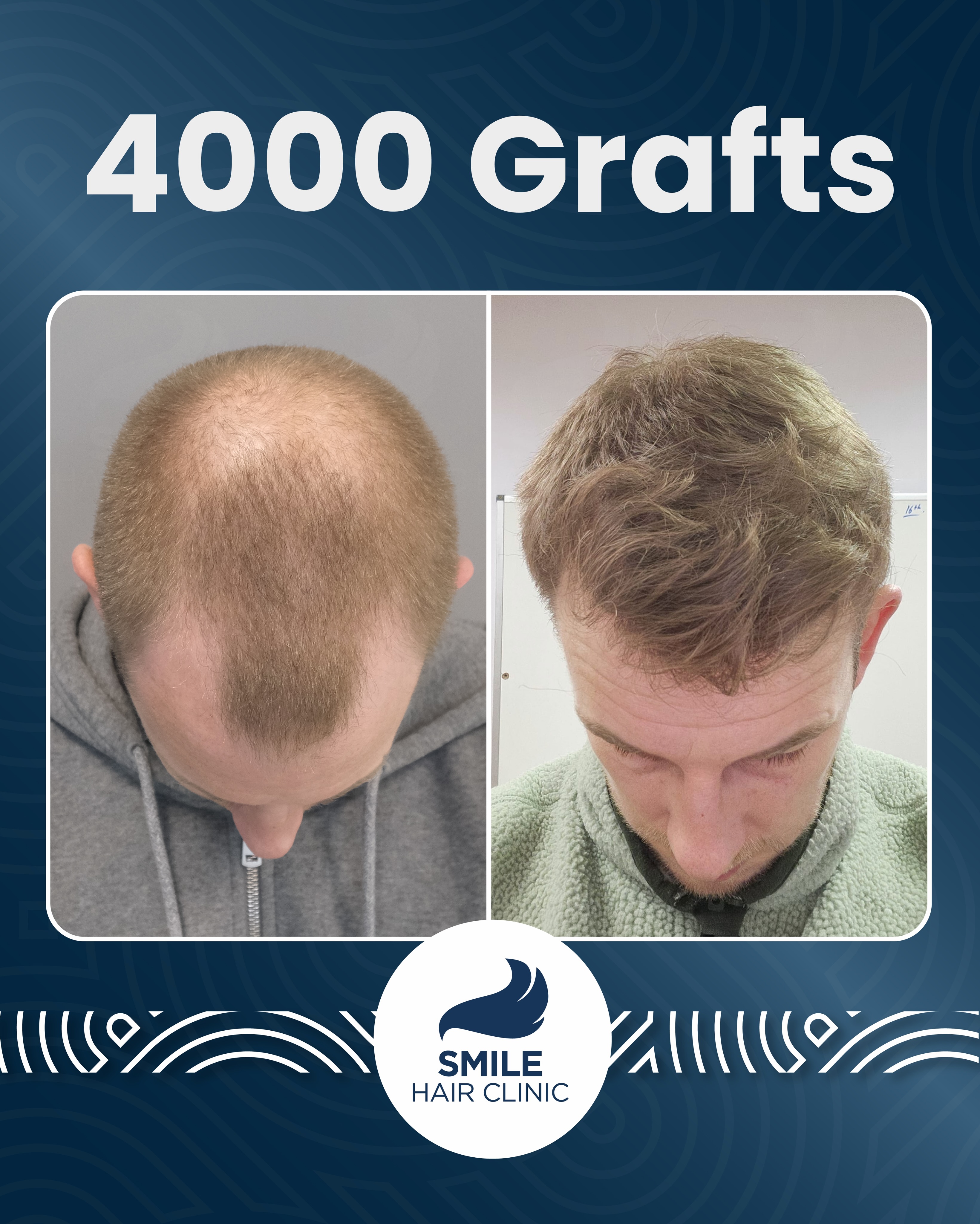 Before and After  graft    transplant at 