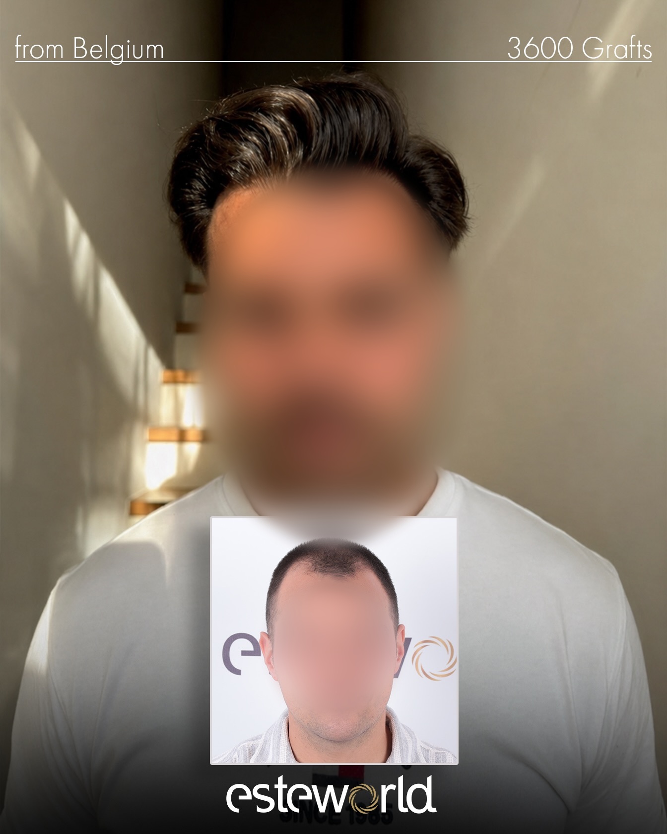 3600 graft DHI hair transplant result before and after
