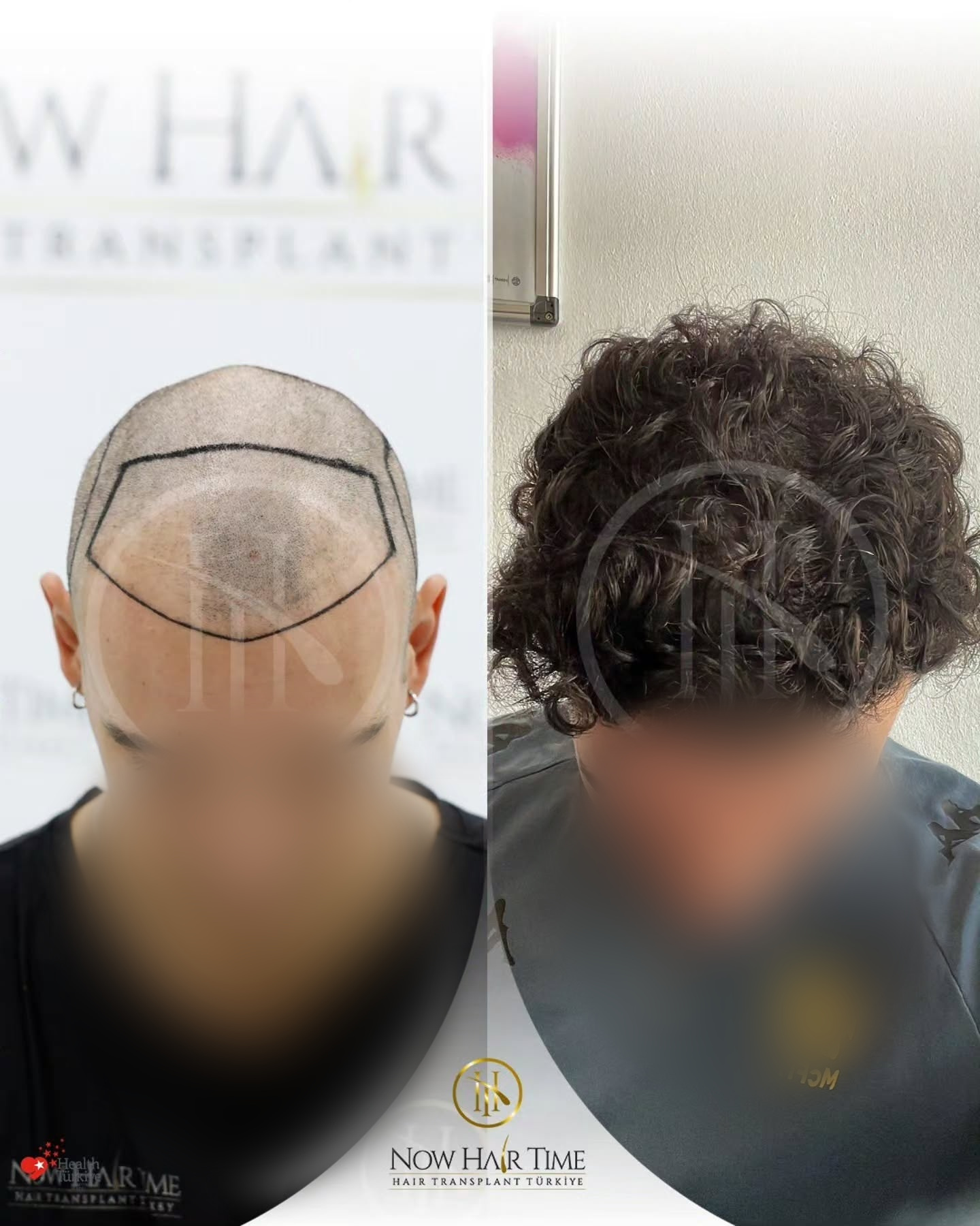 4500 graft SAFIR hair transplant result before and after