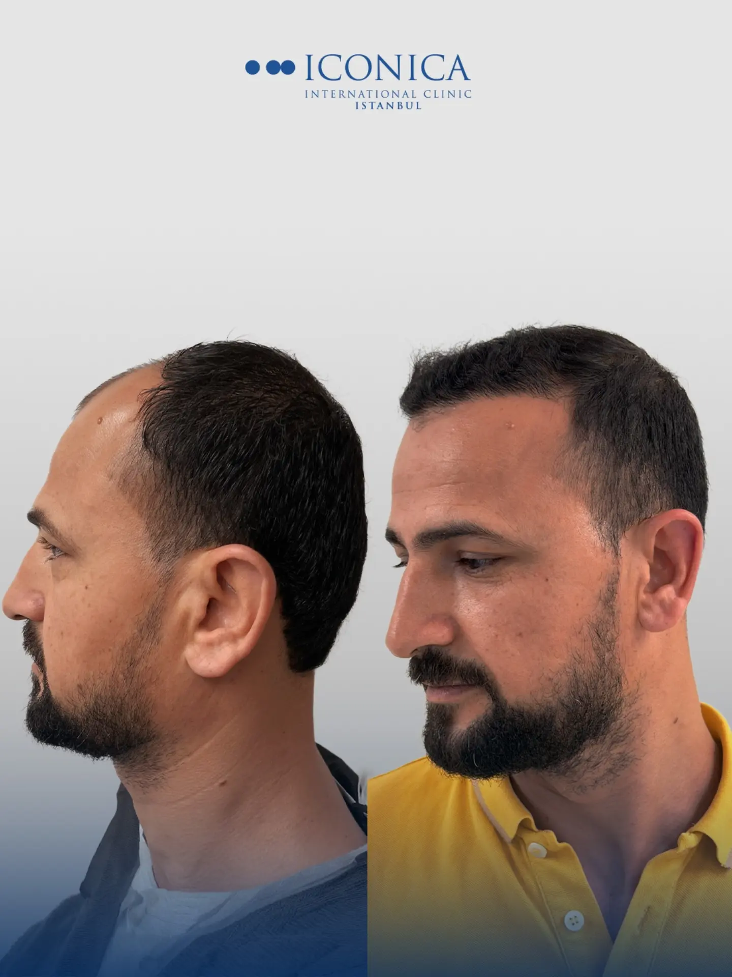 Before and After  graft    transplant at 