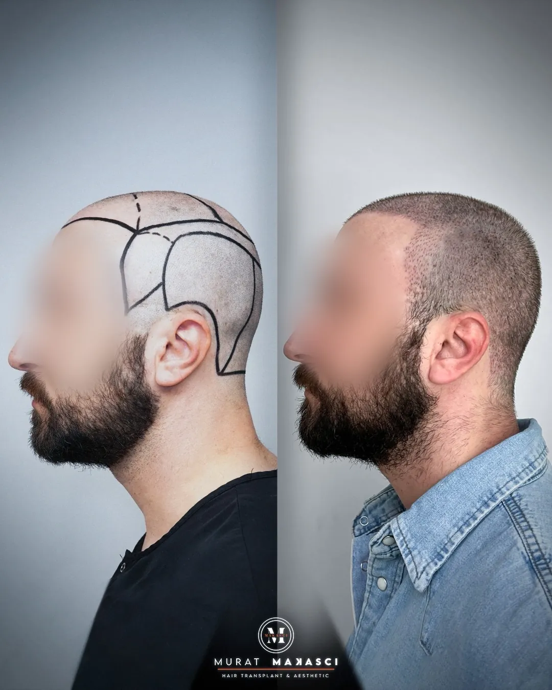 5650 graft DHI hair transplant result before and after