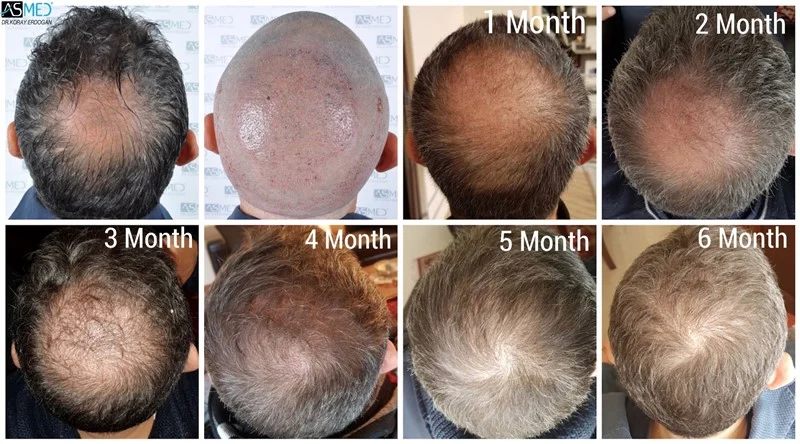 3023 graft FUE hair transplant result before and after