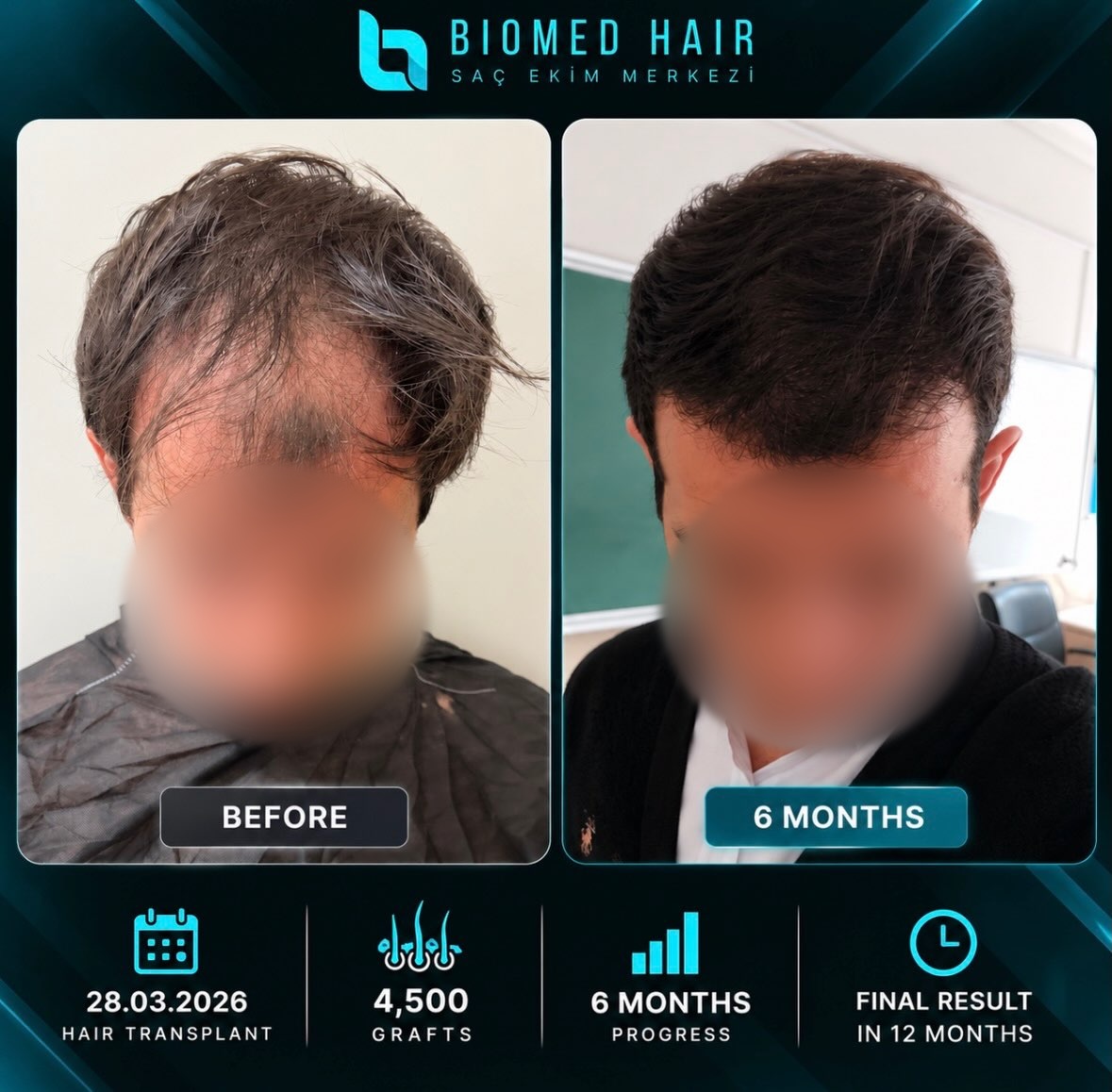 4500 graft DHI hair transplant result before and after