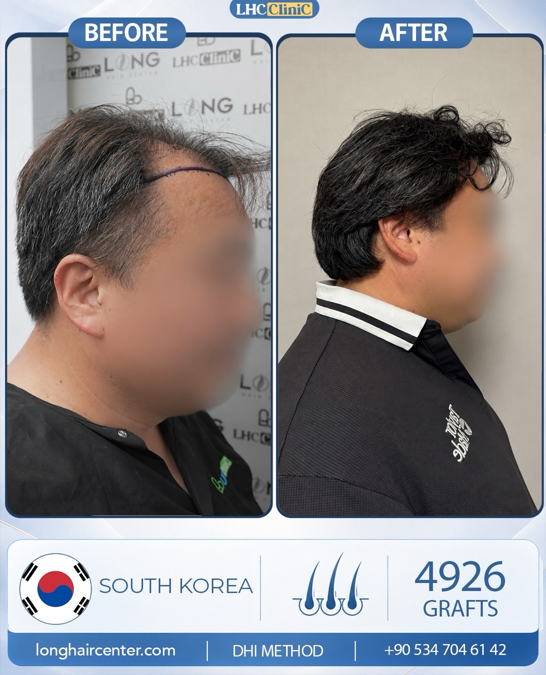 Before and After  graft    transplant at 