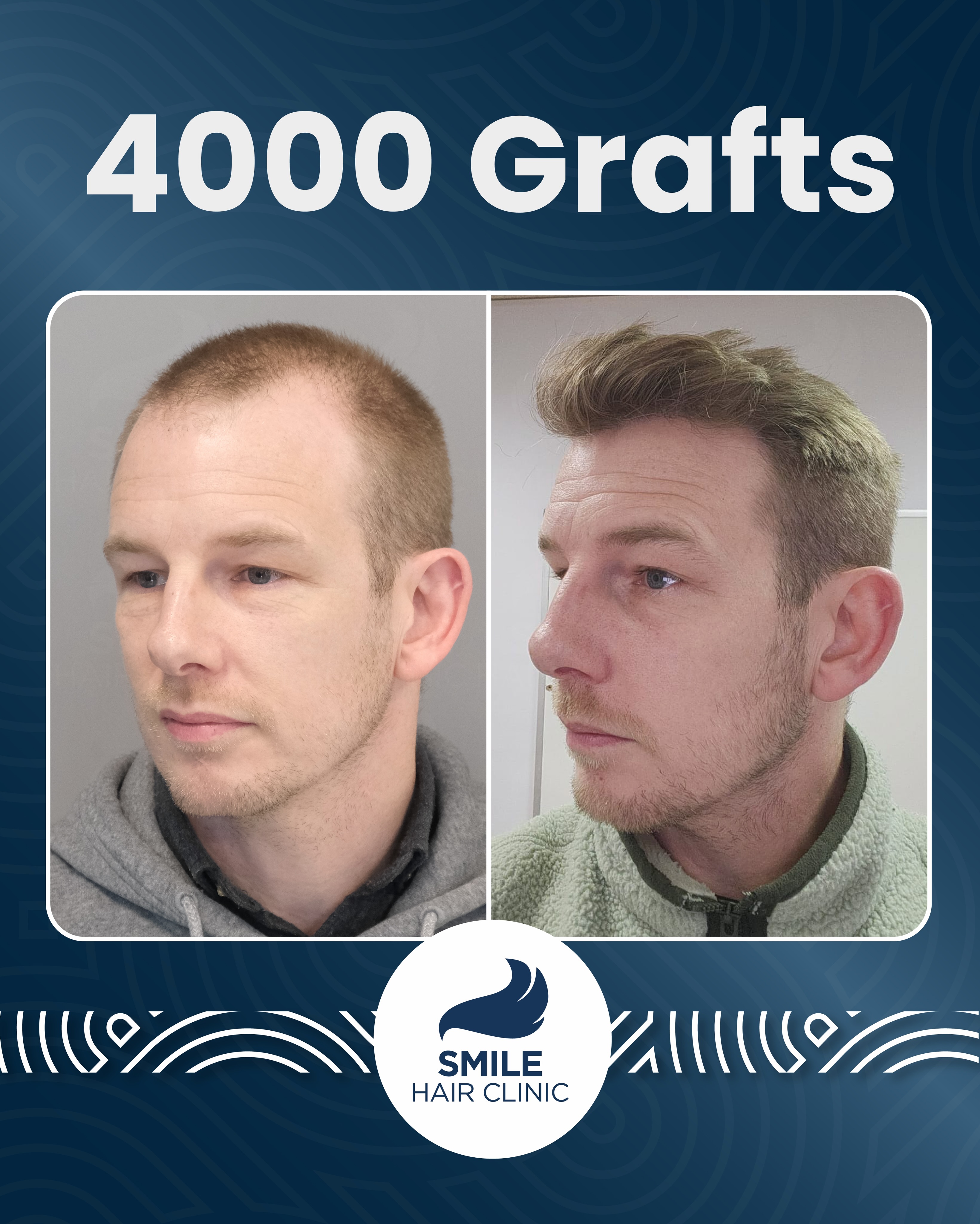 Before and After  graft    transplant at 