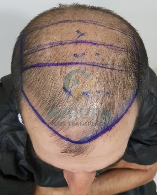 5500 graft FUE hair transplant result before and after