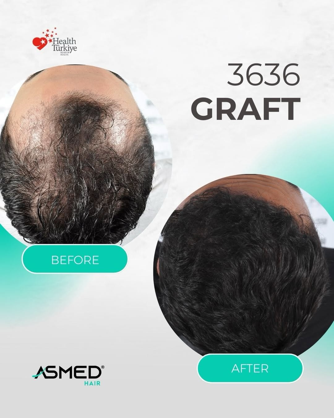 FUE Hair Transplant Result
