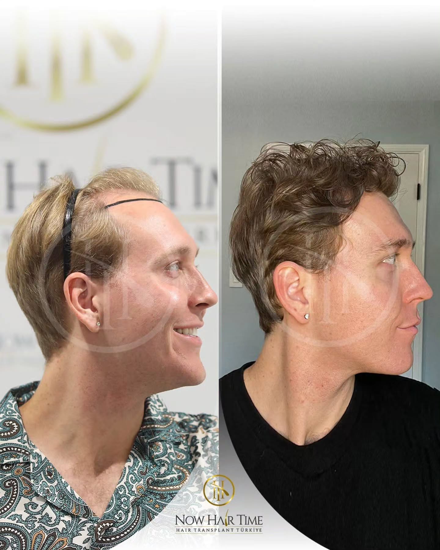 Before and After  graft    transplant at 