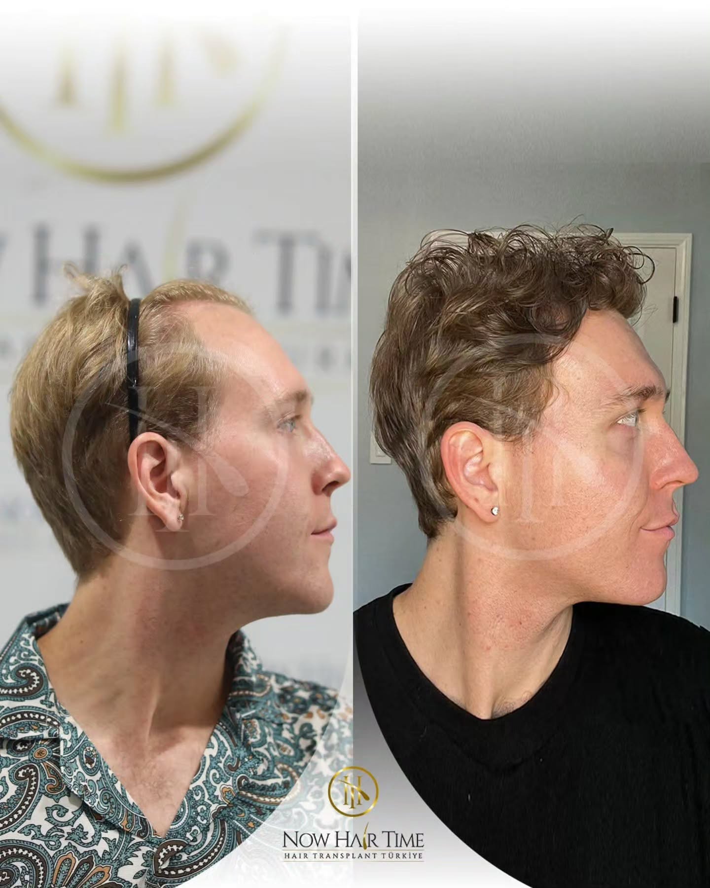 Before and After  graft    transplant at 