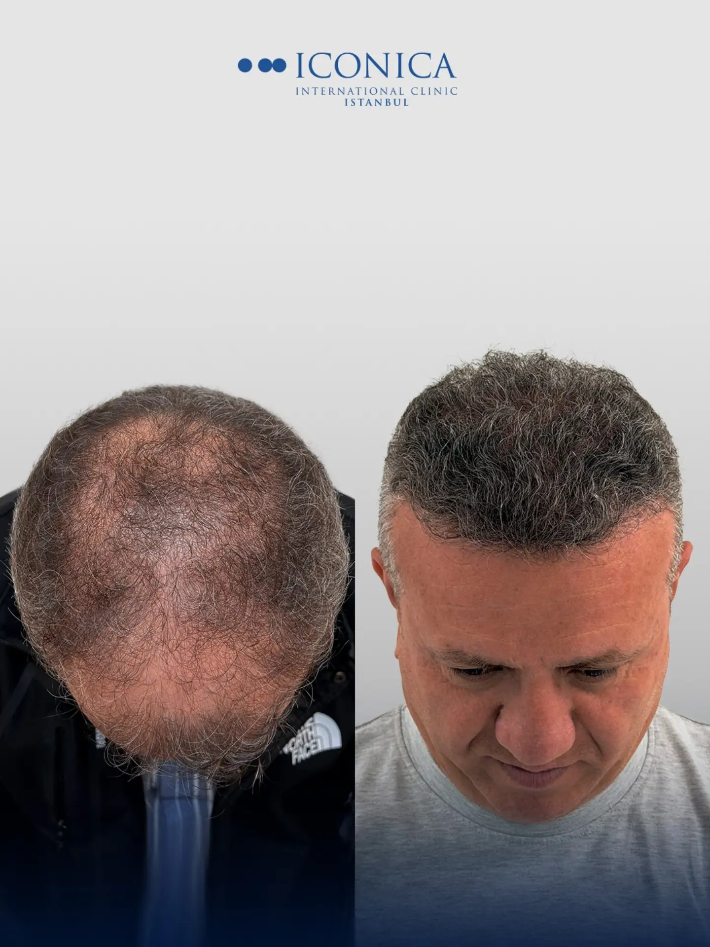 Before and After  graft    transplant at 