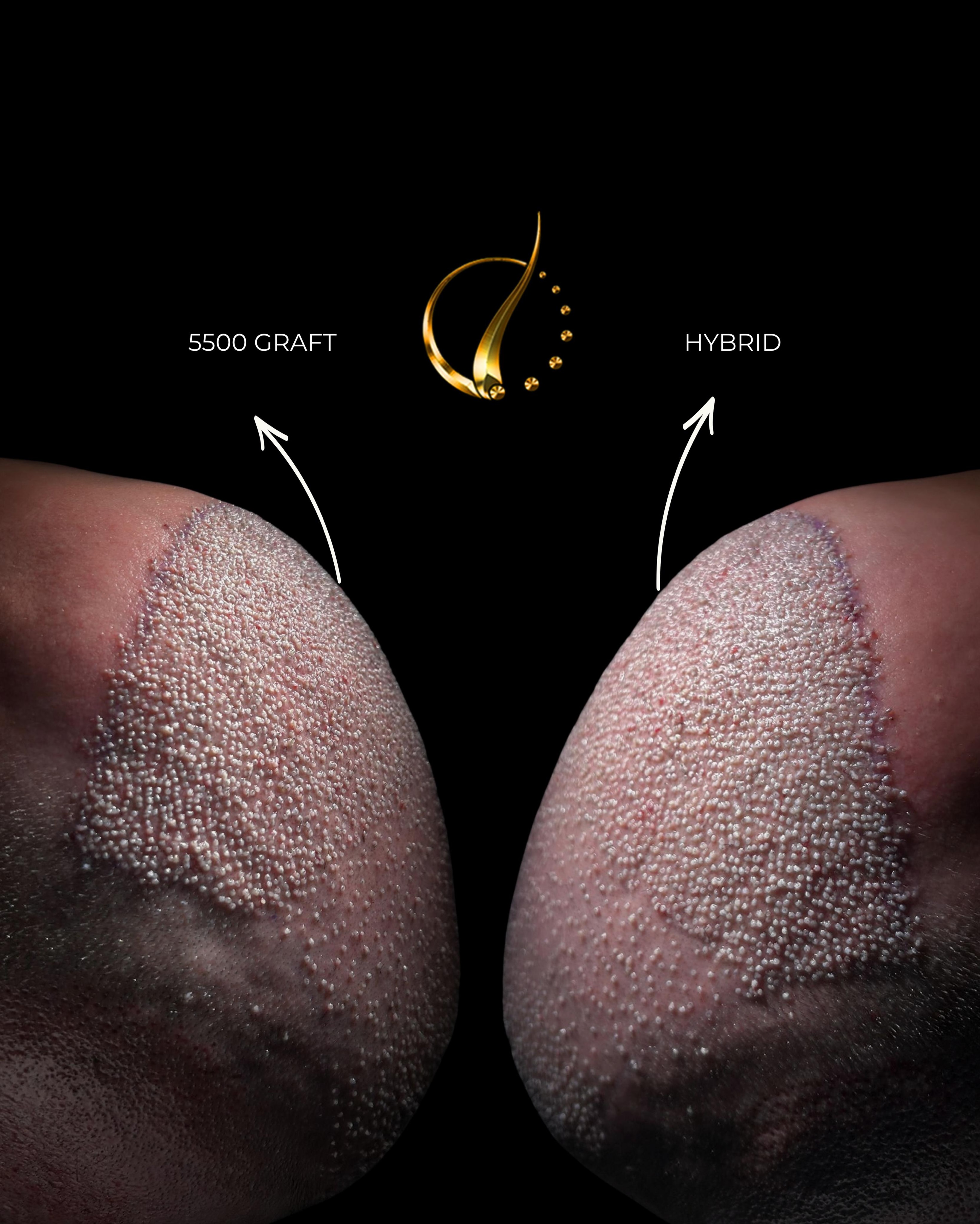 Before and After  graft    transplant at 