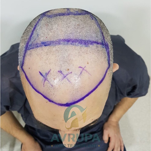 4100 graft FUE hair transplant result before and after