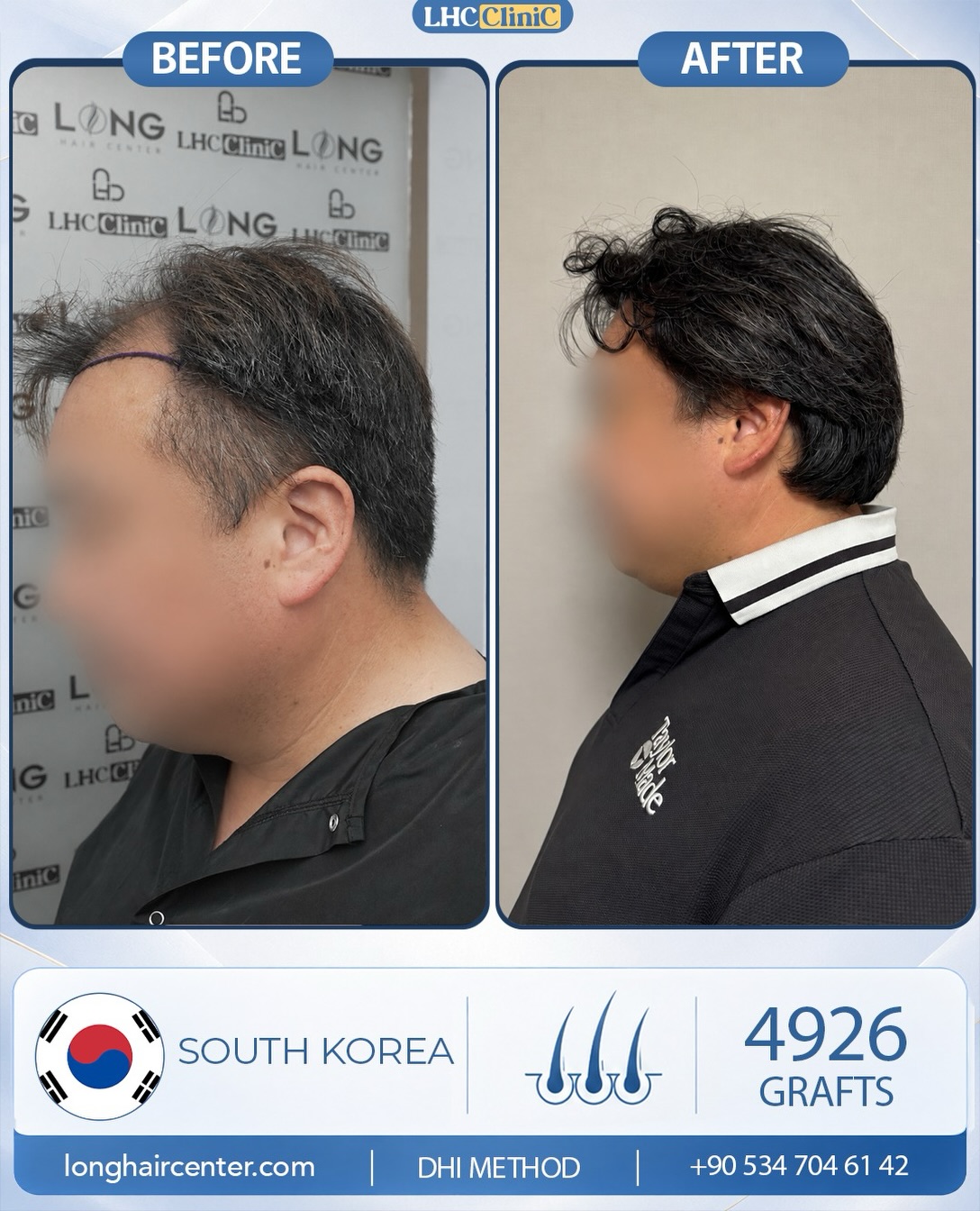 Before and After  graft    transplant at 