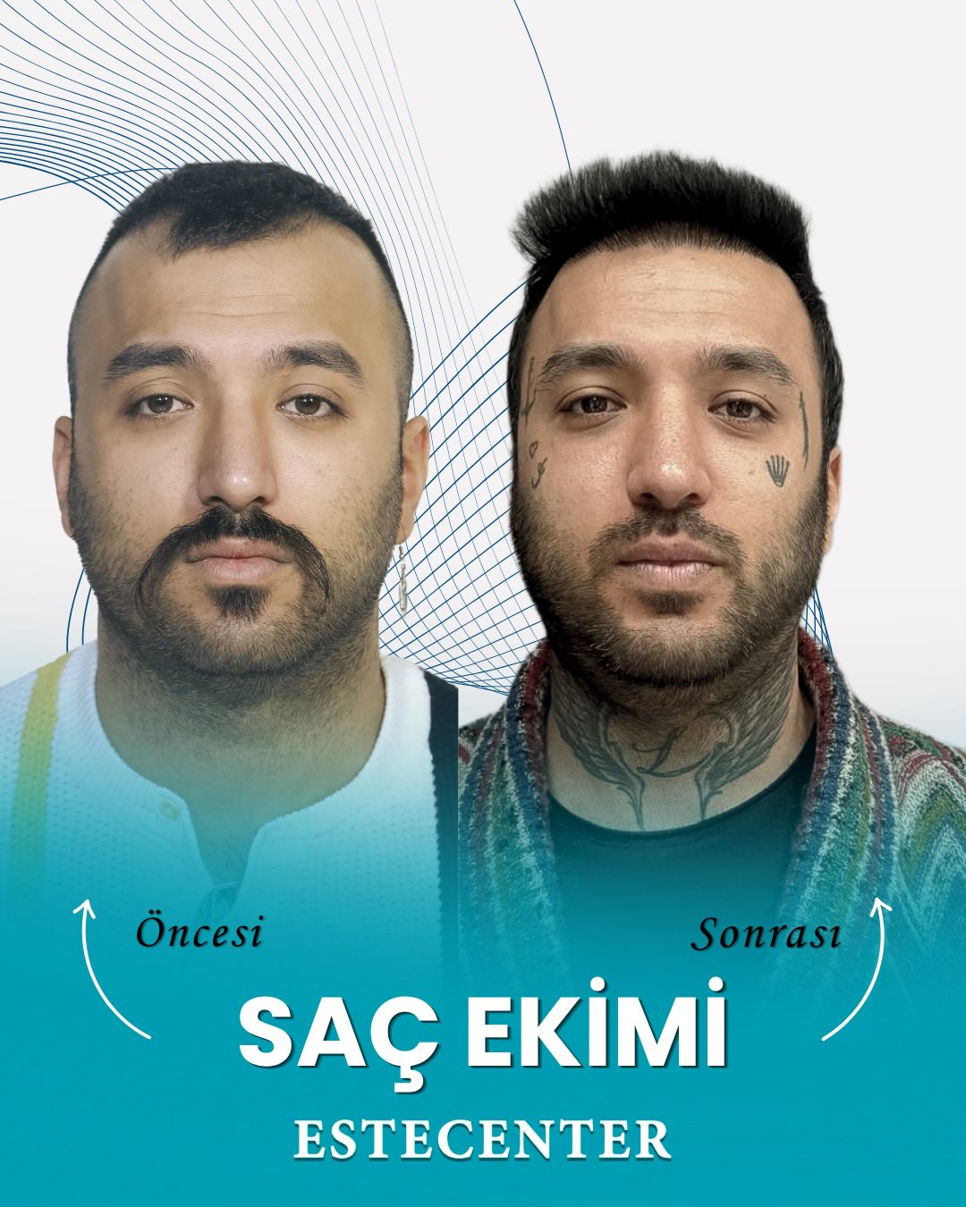 Before and After 3500 graft  FUE hair transplant at Estecenter