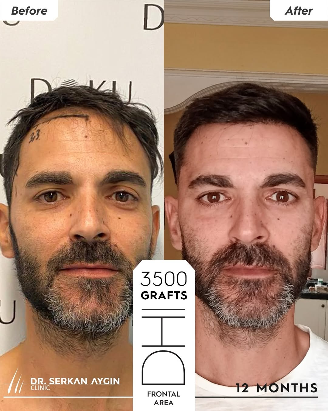 DHI Hair Transplant Result