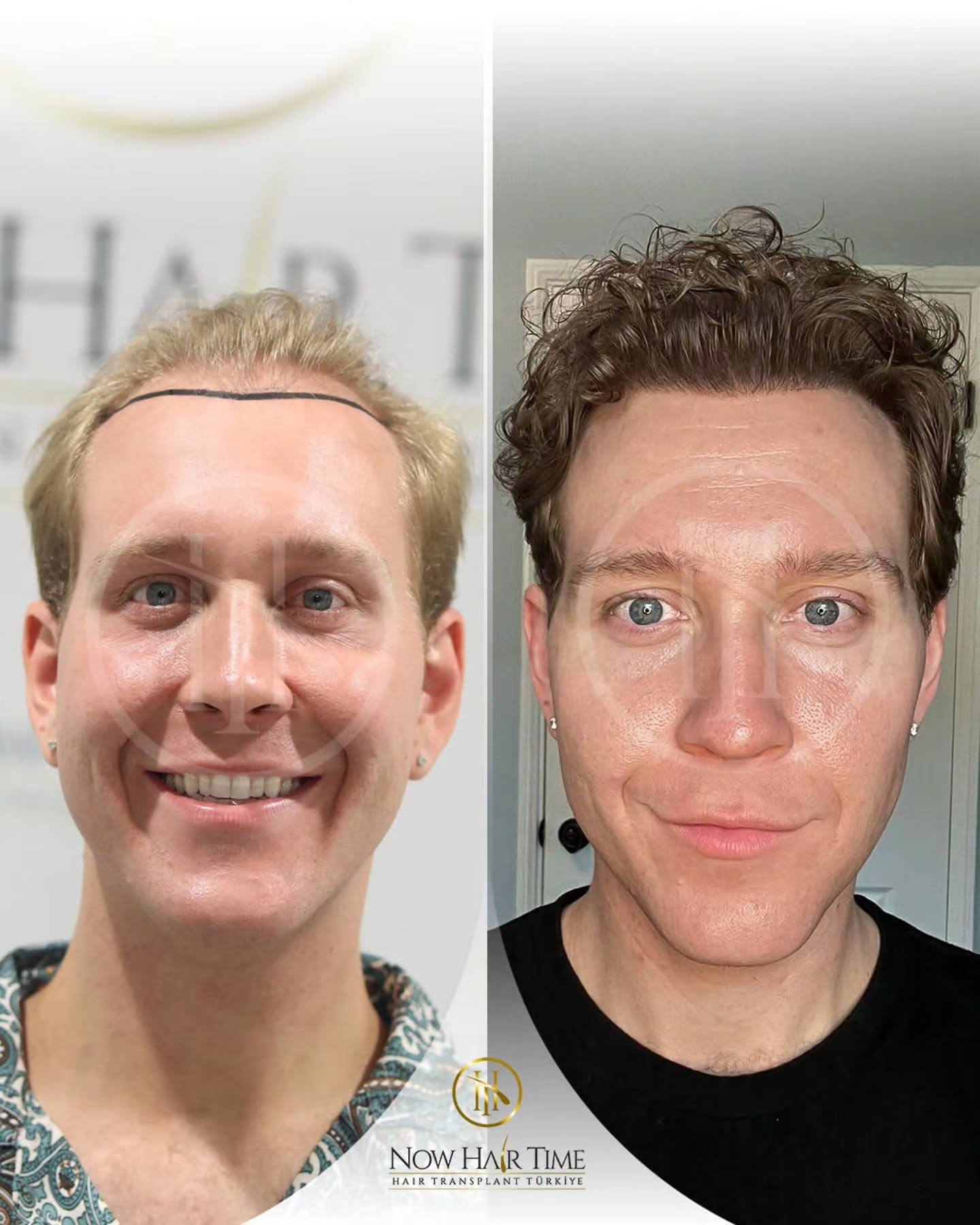 4250 grafts FUE hair transplant result before and after