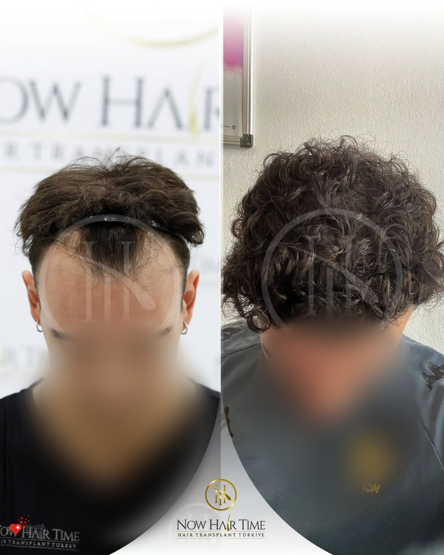 Before and After  graft    transplant at 
