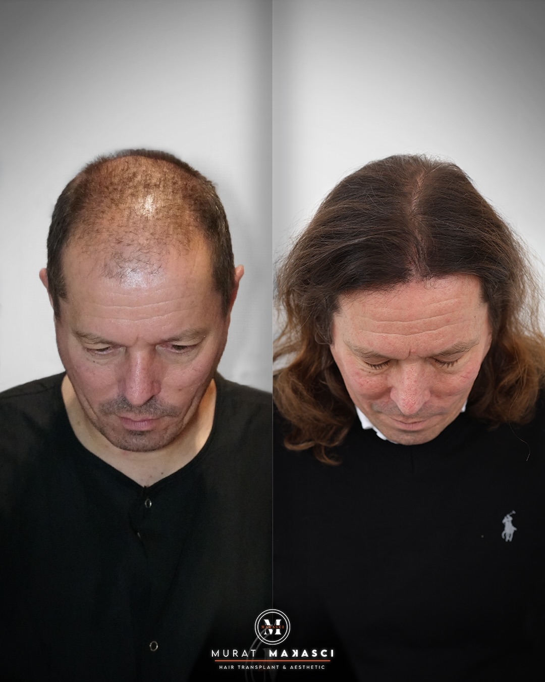 Before and After  graft    transplant at 