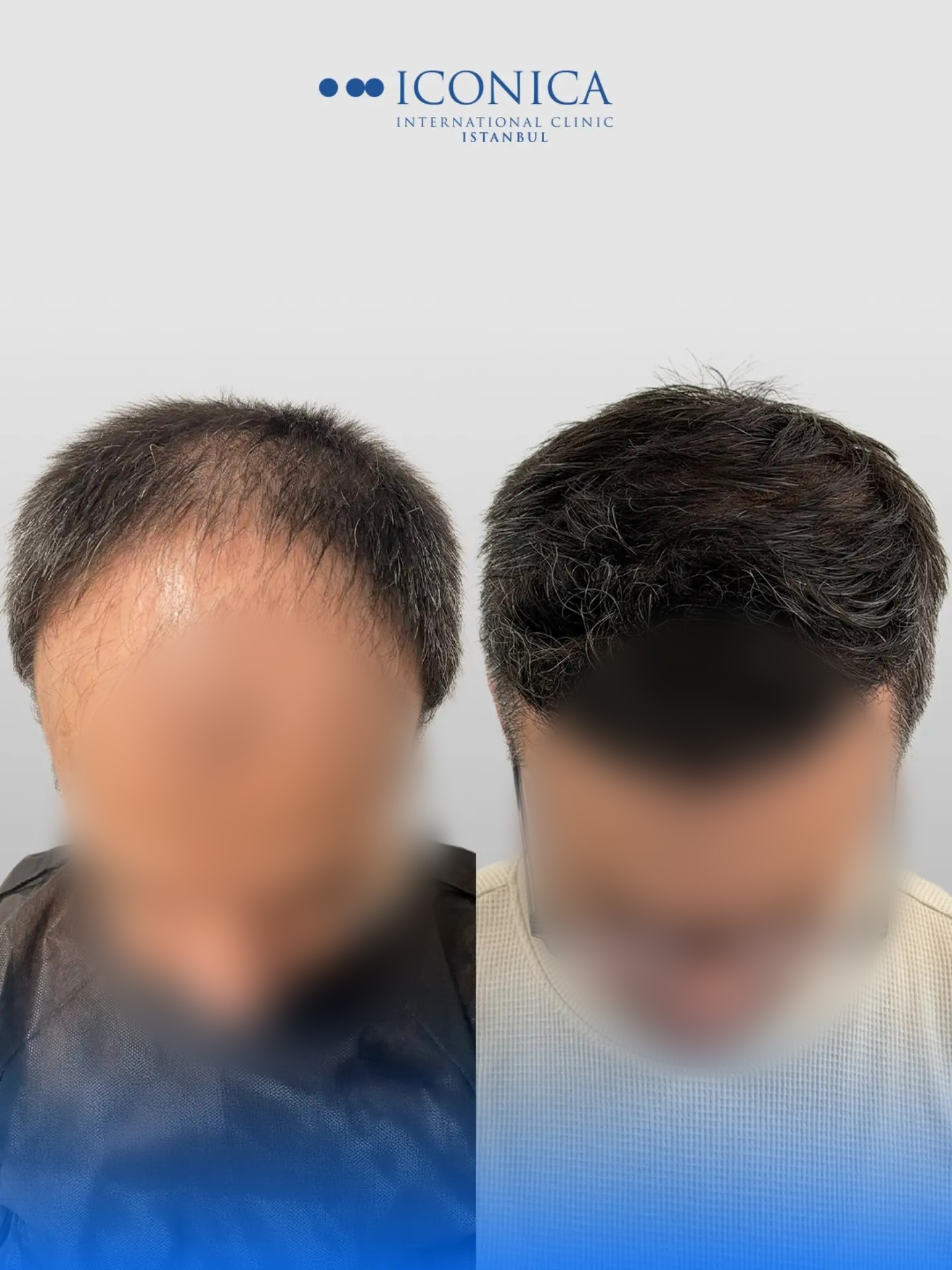 Before and After  graft    transplant at 