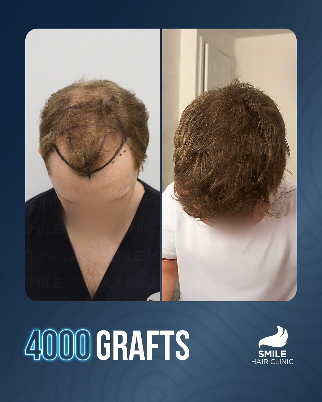 Before and After  graft    transplant at 